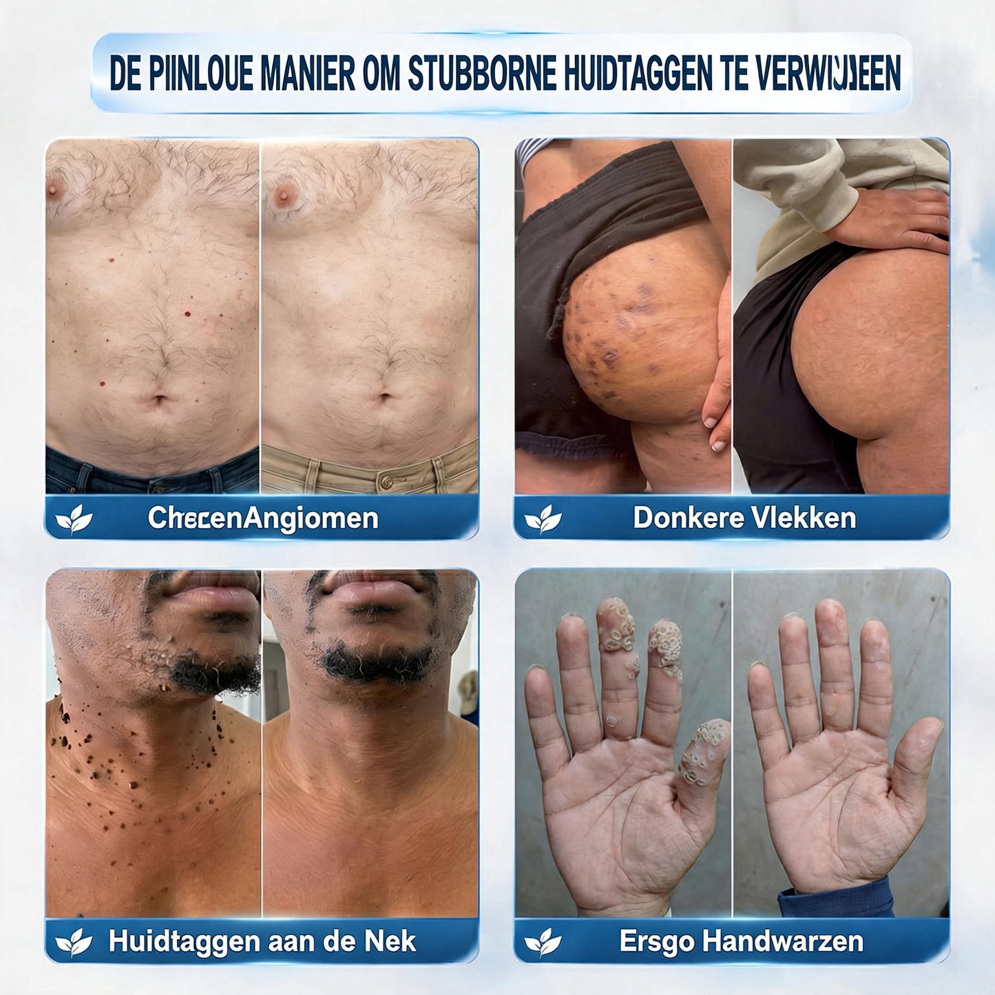 Officiële merkshop | 🖊️Natravor® 7-daagse wratten- en vlekkenverwijderaar (pijnstillende applicator voor nauwkeurig aanbrengen, laat geen littekens achter)🌳